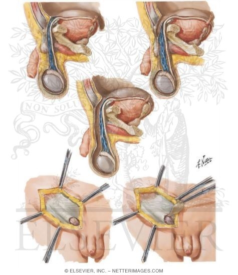 Hernia I - Indirect and Direct Inguinal Hernias