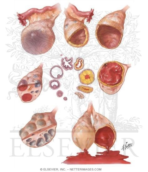 Diseases of the Ovary: Physiologic Variations, Nonneoplastic Cysts