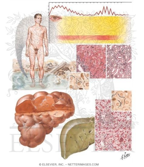 Spirochetal Infections - Weil's Disease, Syphilis
