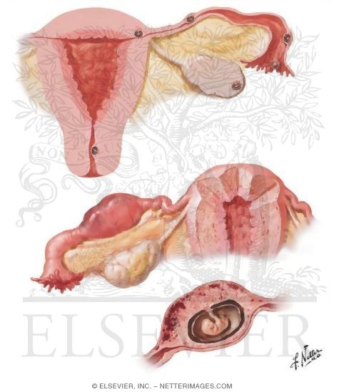 Ectopic Pregnancy I - Tubal Pregnancy