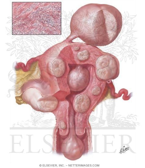 Myoma (Fibroid) I - Locations - Netter Medical Images
