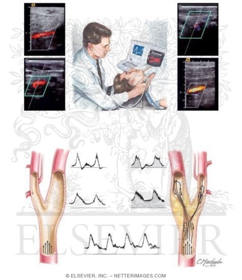 Noninvasive Evaluation of Carotid Arteries