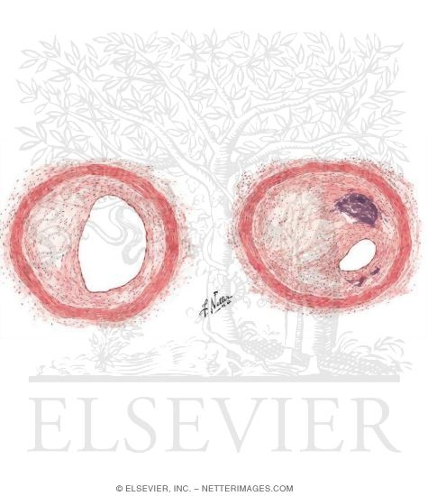 Types and Degrees of Coronary Atherosclerotic Narrowing or Occlusion
