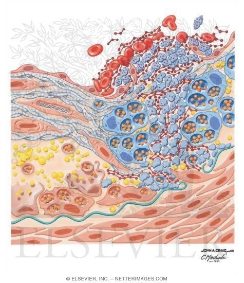 Atherogenesis: Unstable Plaque Formation