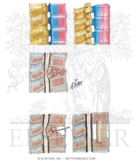 Three-Column Concept of Spinal Stability