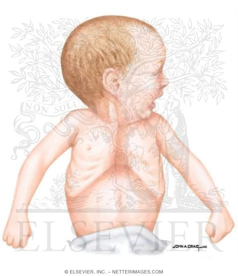 Clinical Characteristics of Too Much Pulmonary Flow (Pulmonary Volume Overload)