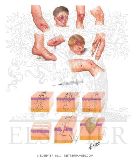 Open Soft Tissue Wounds