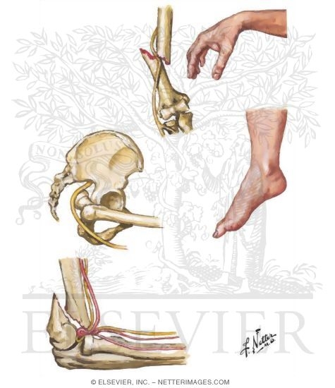 Neurovascular Complications of Fractures