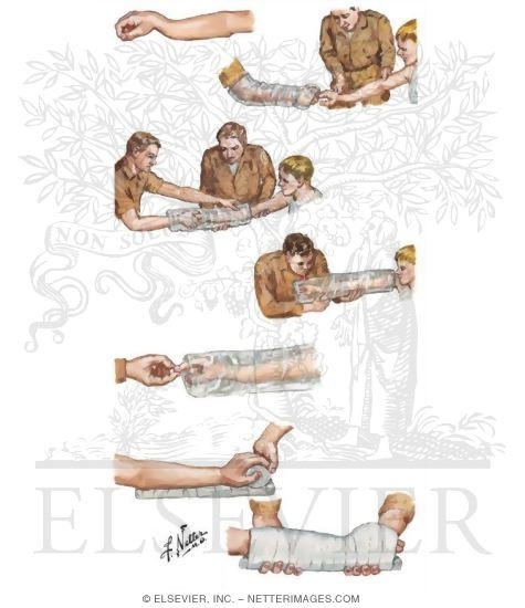 Prehospital Care of Fracture of Forearm Bones and Prehospital Care of Fracture of Wrist and Hand
