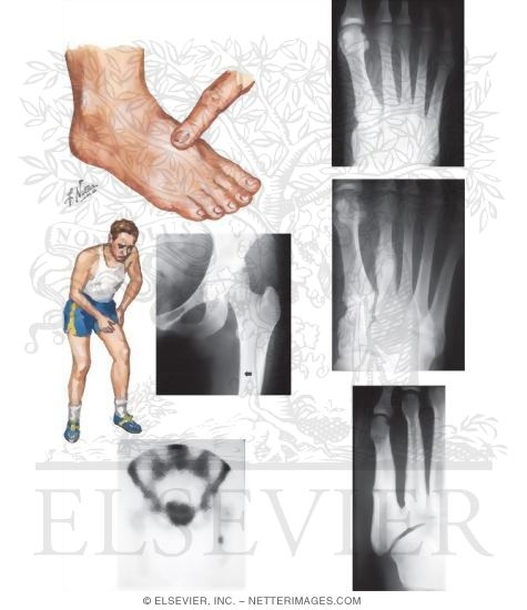 Stress Fracture