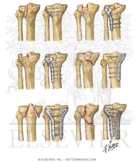 Fracture of Proximal Tibia Involving Articular Surface