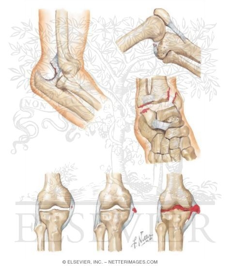 Types of Joint Injury