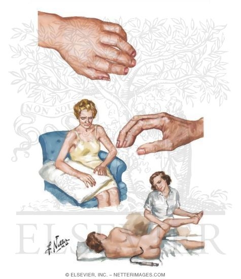 Reflex Sympathetic Dystrophy