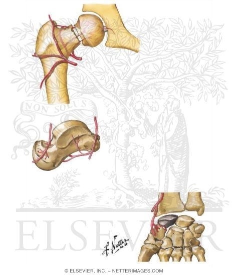 Osteonecrosis After Fracture