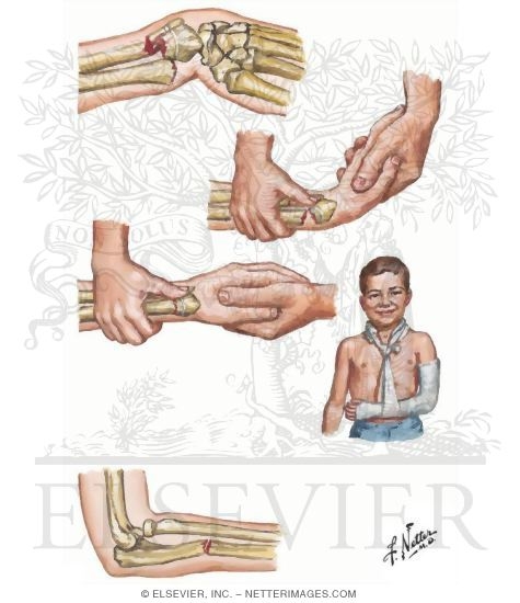 Fracture of Forearm Bones in Children