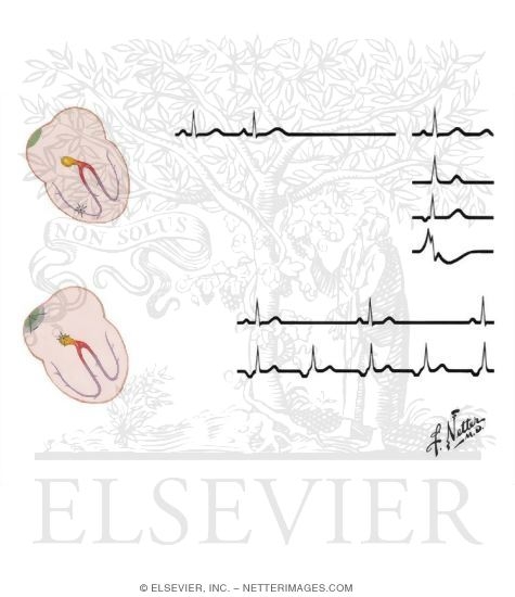 Sinus Arrest and Sinus Block