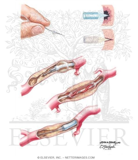 Percutaneous Coronary Intervention, Atherectomy Procedures