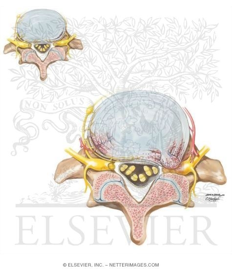 Role of Inflammation In Lumbar Pain