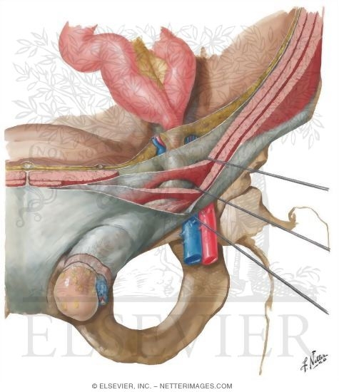 Coverings of Complete Indirect Inguinal Hernia
Hernia I - Indirect and Direct Inguinal Hernias
Indirect Inguinal Hernia