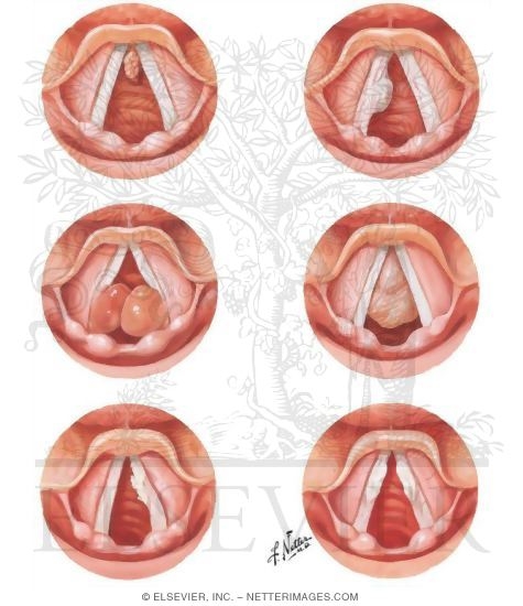 Miscellaneous Disorders of the Larynx
Lesions of the Vocal Cords