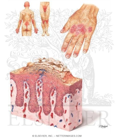 Plaque Psoriasis