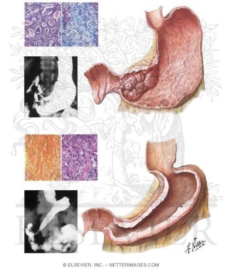 Upper Gastrointestinal Tract Cancer