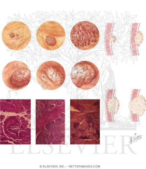 Tumors of the Bladder