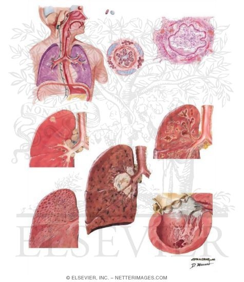 Causes of Chronic Cough