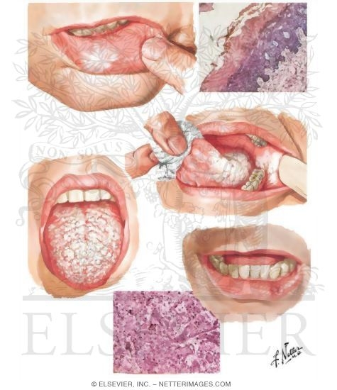 Leukoplakia