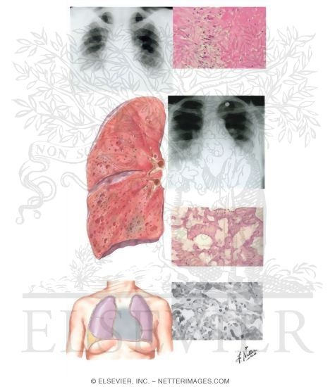 COLLAGEN VASCULAR DISEASE collagen vascular disease:
