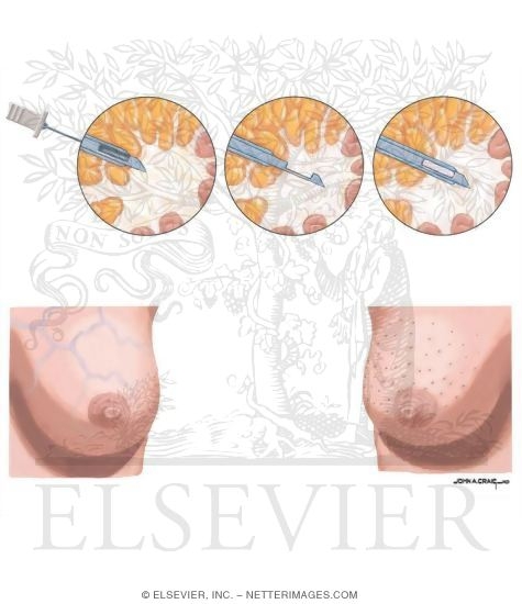 Breast: Cancer
