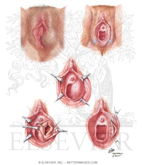 Bartholin's Gland: Cysts