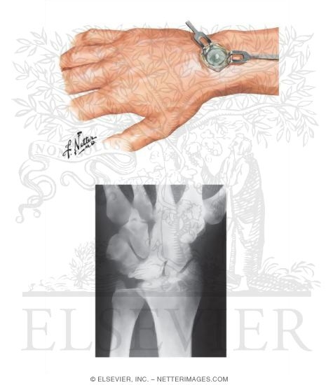 Ganglion of Wrist
Kienbock's Disease