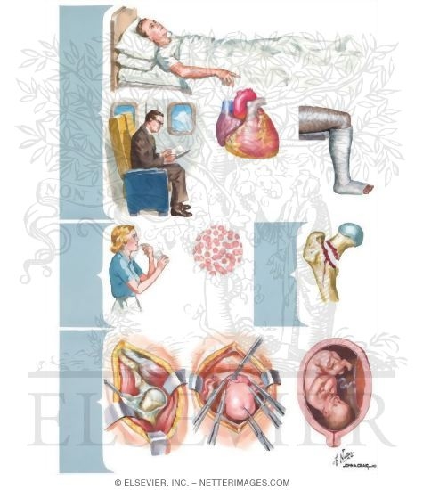 Predisposing Factors for Pulmonary Embolism