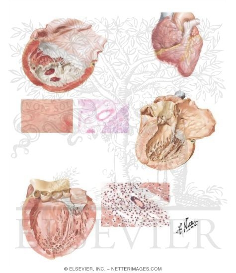 Idiopathic and Infiltrative Causes of Restrictive Cardiomyopathy