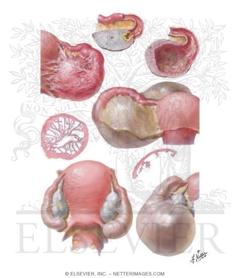 Hydrosalpinx (Chronic Pelvic Inflammatory Disease)