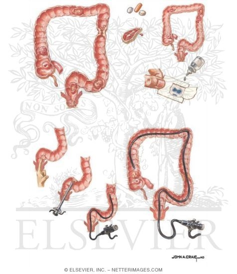 Colorectal Cancer: Screening Techniques