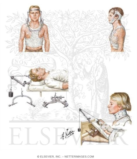 cervical spine traction