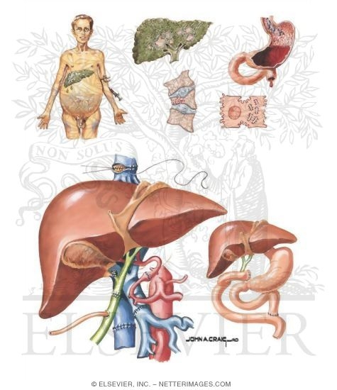 Various Pathologies and Surgical Procedures Involving the Liver Including a Liver Transplant