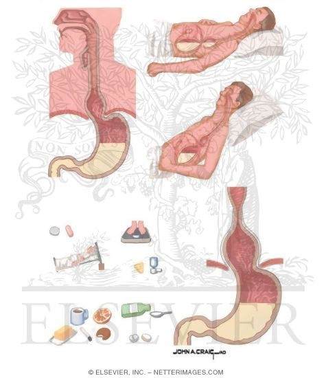 umbilical hernia in adults. umbilical hernia in adults.