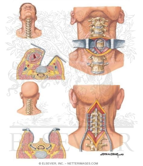 Anterior and Posterior Approach to Cervical Spine