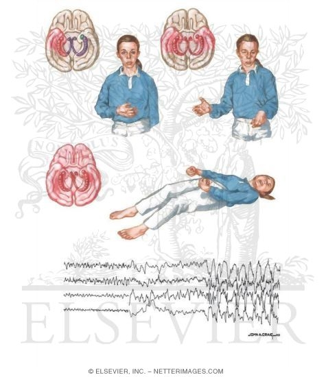 Temporal Lobe Epilepsy