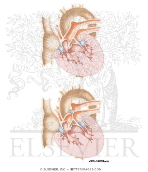 Ventricular Septal Defect