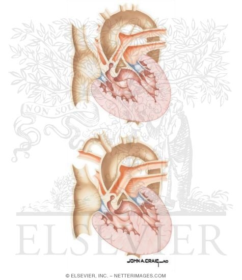 Tetralogy fallot in adults