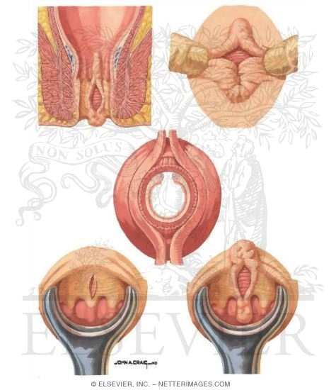 Anal Fissure