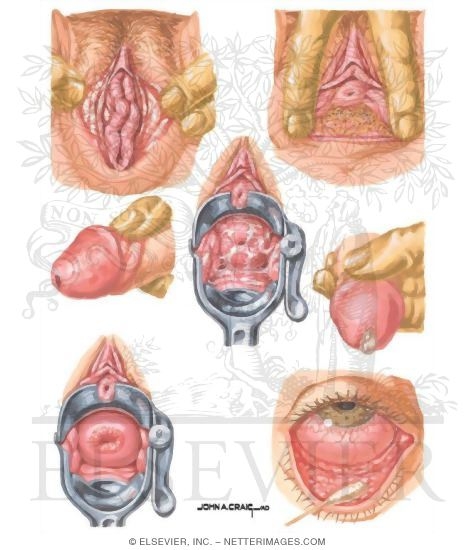 Welcome folks, today I want post interesting topic about tattoo infection