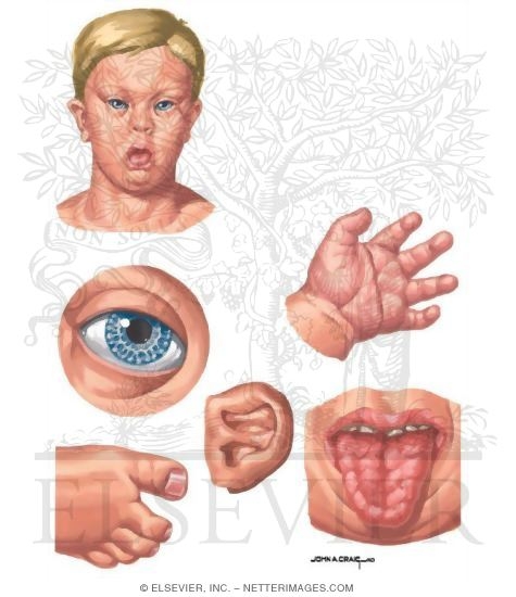Phenotypic Abnormalities: Terminology and Classification - hand characteristics.