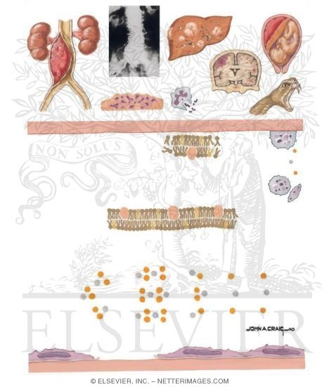 Disseminated Intravascular Coagulation (DIC)