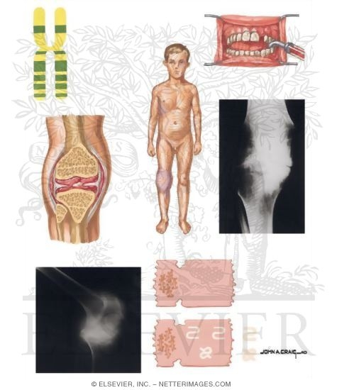 Hemophilia A Pictures