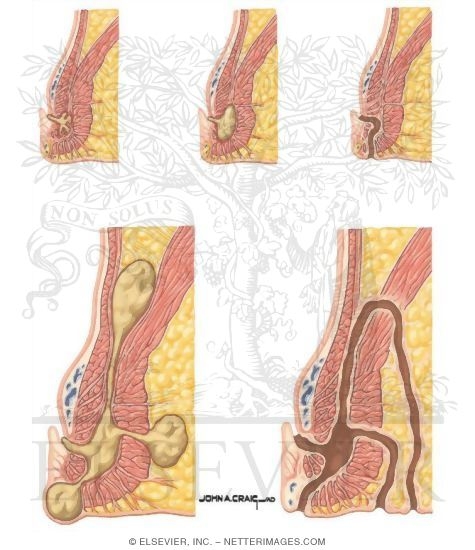Anorectal Abscesses